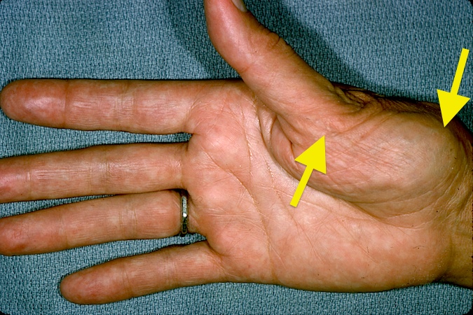 Osteoarthritis Carpometacarpal Cmc Joint Of Thumb Hand Surgery Resource 6767